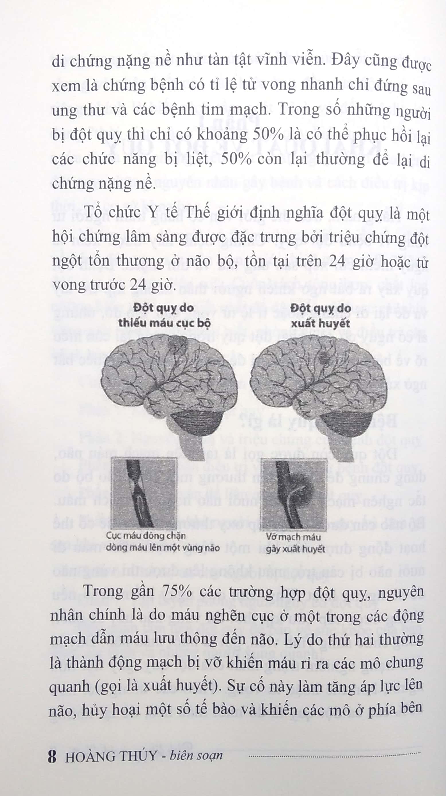 bệnh đột quỵ và cách điều trị