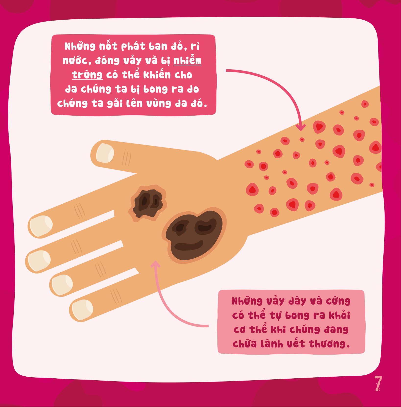 có thể bạn chưa biết - vì sao chúng ta... bị bong da?